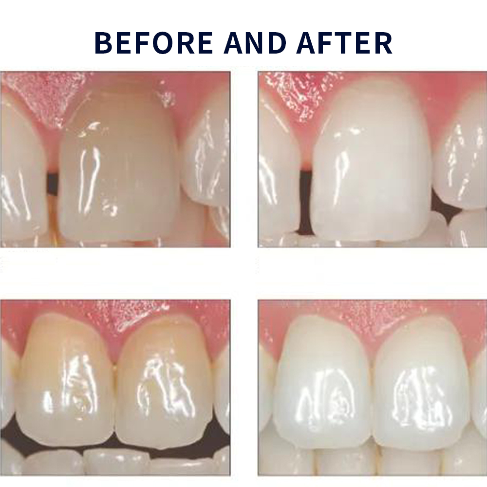 Opalescence Whitening 20% PF 2 - огляд і ціна Teeth Whitening Hydrogen Peroxide