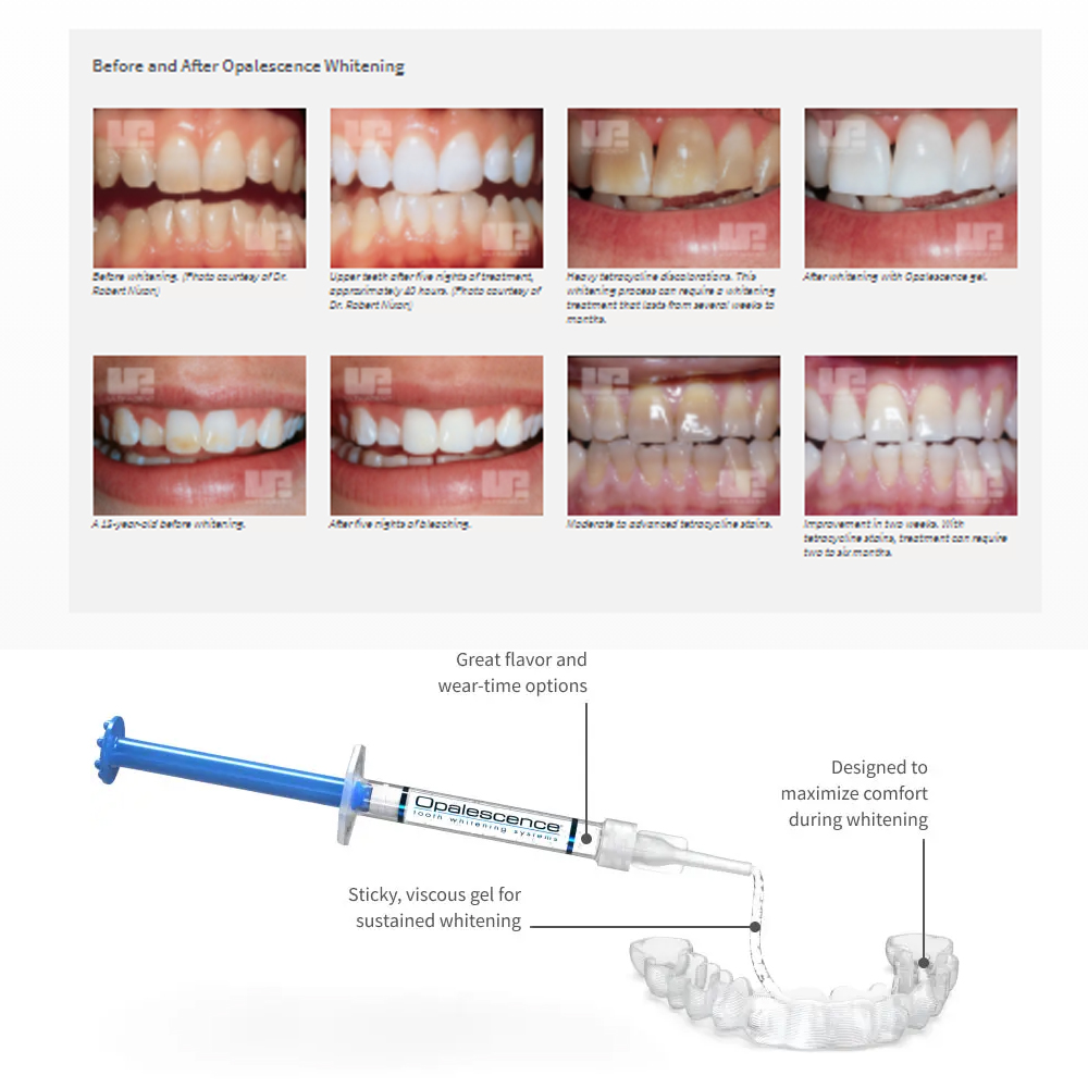 Opalescence Whitening 20% PF 2 - огляд і ціна Teeth Whitening Hydrogen Peroxide