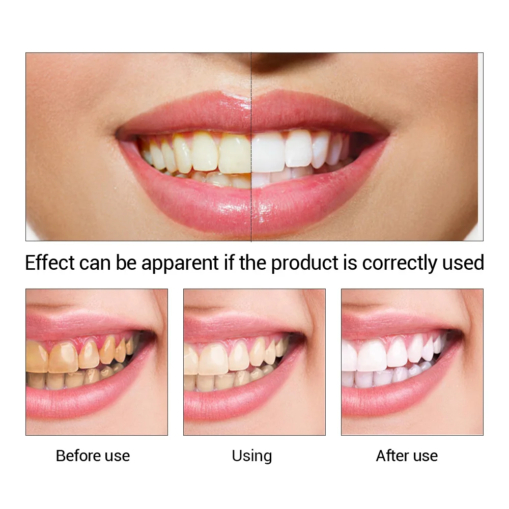 FTEENPLY Teeth Whitening Essen - огляд і ціна Teeth Whitening Quotes