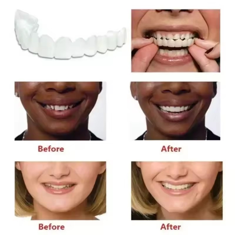 Teeth Veneers Whitening Dentur - огляд і ціна Teeth Whitening For Braces