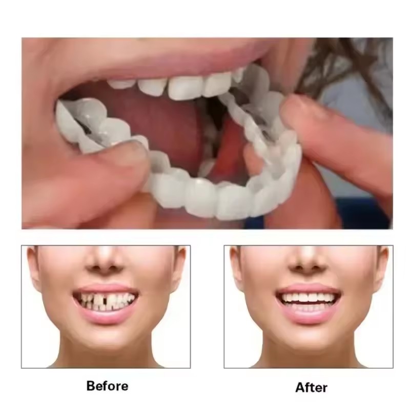 Teeth Veneers Whitening Dentur - огляд і ціна Teeth Whitening For Braces