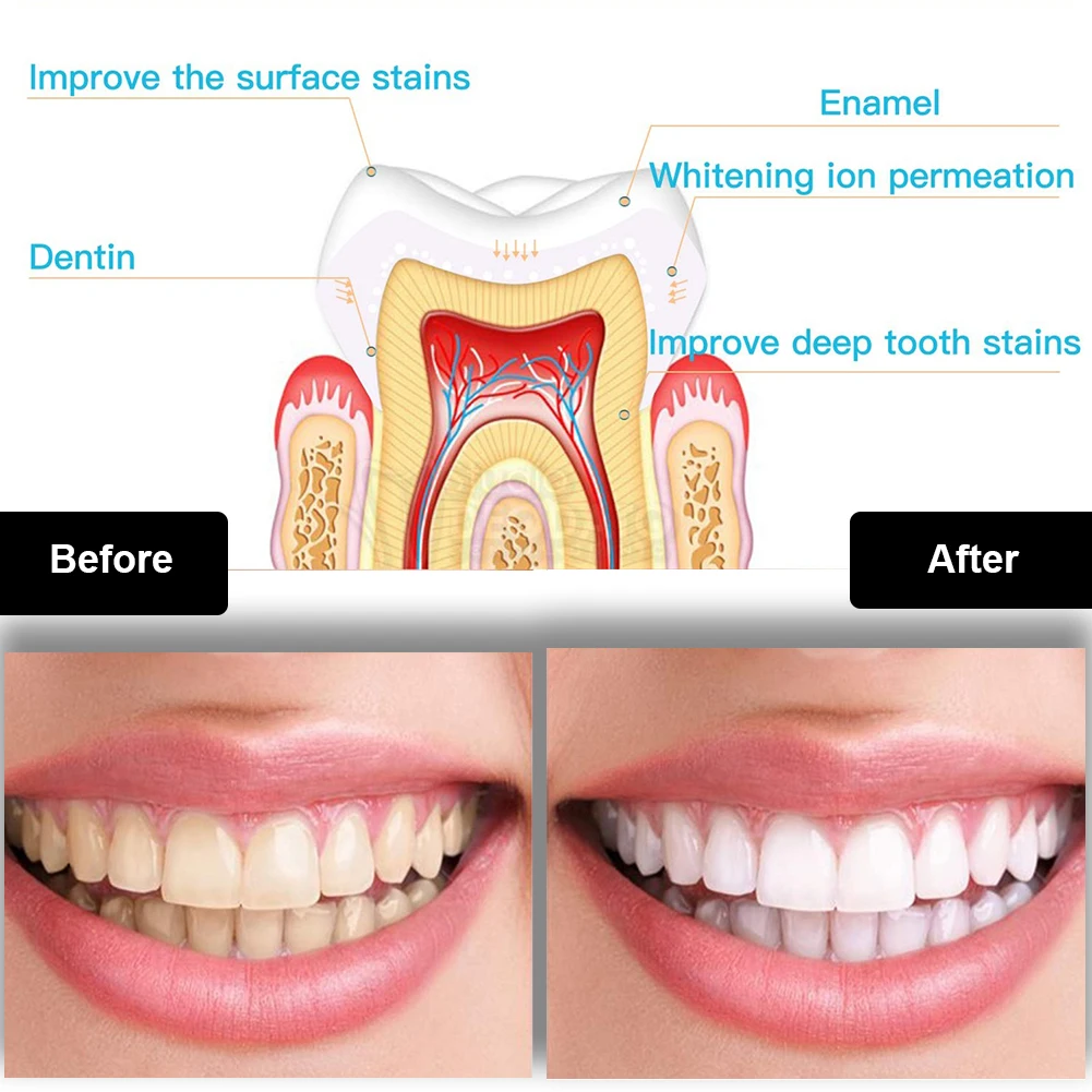 Dental Teeth Whitening Kit Min - огляд і ціна Teeth Whitening Kit With Light